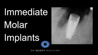 *ASC Abutment - Why on an implant molar? - Dr. Scott MacLean