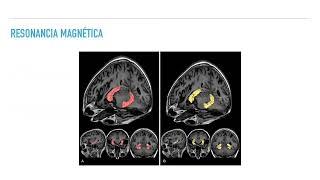 Enfermedad de Alzheimer