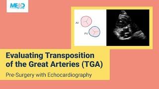 Evaluating Transposition of the Great Arteries (TGA) Pre-Surgery with Echocardiography