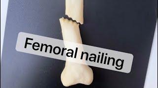 Playdough Surgery - Femoral Nailing (AKA femoral shaft fracture intramedullary nailing)