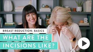 Where Are the Incisions & Scars for a Breast Reduction? | Real Answers from Real Women