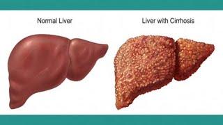 Living With Cirrhosis