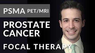 PSMA PET/MRI, Prostate Cancer Patients and Focal Therapy