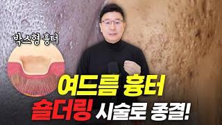 숄더링 시술, 박스형 여드름 흉터치료의 핵심입니다~!