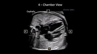 Basic Fetal Echo Protocol and Optimization