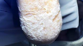 The Soles Of The Feet Are Covered With A Thick Layer Of White Calluses【Pedicure Master Lin Jun】