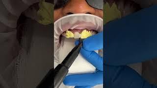 Gap closure using composite veneers 