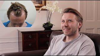 Dan's FUE Hair Transplant Results