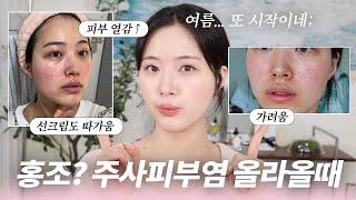 광고 여름마다 시작되는 피부열감... 붉어지고 가렵고 피부 뒤집어진거 회복시킨 루틴 알려드릴게요!