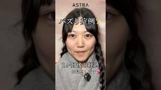 キレイすぎる変化#astrabeautyclinic  #アストラビューティークリニック #塩満恵子 #鼻整形 #美容整形 #忘れ鼻