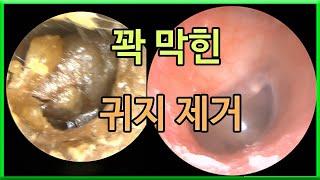 꽉 막힌 귀지 제거 | 이비인후과에서 딱딱한 귀지 제거하는 내시경 영상 | cerumen impaction  |  hard ear wax removal | 오공작가