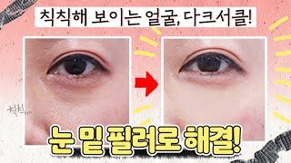 눈밑 꺼짐 필러, 소량의 필러로 다크서클 해결하기!!(ft. 눈밑필러시술기)
