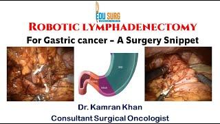Robotic D2 lymphadenectomy for Gastric cancer - A surgery Snippet - Edusurg Clinics