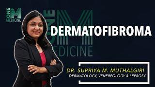 Chapter 55-D | Dermatofibroma | Dermatology | OneMedicine