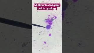 Multinucleated giant cell in cytology (40x view) #Cytology #Pathology