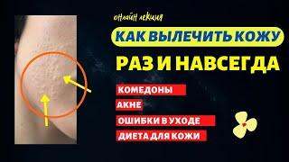 как вылечить акне | проблемная кожа у подростков | как убрать комедоны