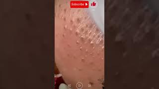 Skincare | Blackheads Removal #490 #tweezers skincare #blackheads blackheads