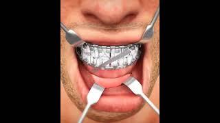 Jaw Bone Repairing (3D Animation) #shorts