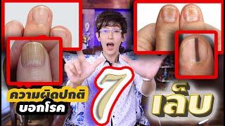 อาการของเล็บ บอกโรคทั้ง 7 นี้....(รีบเช็คตัวเองด่วน!) เล็บนิ่ม เล็บเปราะแก้ได้