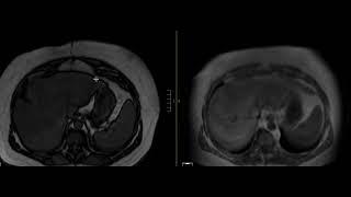 Focal Fatty Liver Infiltration