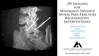 Pars Fracture Defects: New Minimally-Invasive Regenerative Treatment Interventions with 3D Guidance