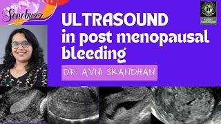 USG IN POST MENOPAUSAL BLEEDING || DR AVNI SKANDHAN ||  #sonobuzz #sonographer