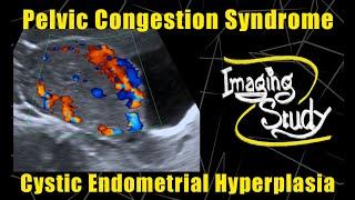 Pelvic Congestion Syndrome & Endometrial Cystic Hyperplasia || Ultrasound || Doppler || Case 90