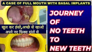 खुल कर हंसो,अच्छे से खाओ अपने नए फिक्स दांतो से Transform Your Smile with Basal Implants ,NEW TEETH