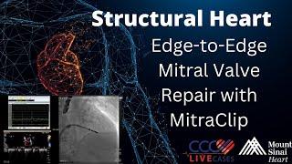 Edge-to-Edge Mitral Valve Repair with MitraClip - July 10, 2018