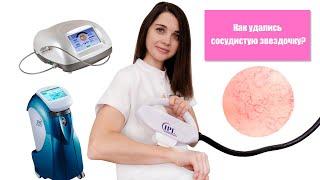 Сосудистая звездочка на лице. Как убрать?