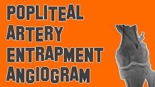 Popliteal Artery Entrapment