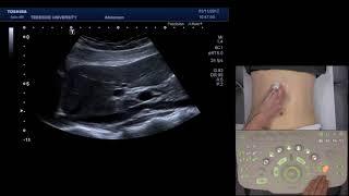 How to scan the Upper Abdomen