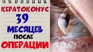  КЕРАТОКОНУС ‍️ Спустя 39 МЕСЯЦЕВ после кератотомии в клинике Арцыбашева 