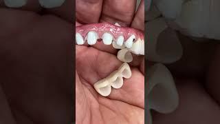 Stunning full mouth implants with ceramics!