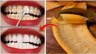 This home remedy will make your yellow, dirty teeth shine like pearls in just 2 minutes / Teeth Whit