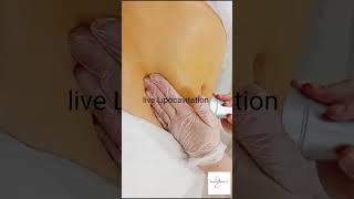 Lipocavitation, solution d'amincissement sans chirurgie