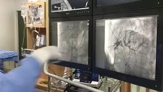 Dr Sandeep Sharma's FHM technique in tight bilateral biliary stenting