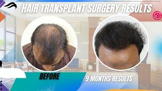 Hair Transplant In Salem | Best Surgeon Cost Clinic & Results Of Hair Transplant In Salem