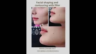 face contouring with filler before and after by dr abbas ashrafzadeh