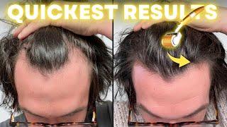 Best Minoxidil Hair Regrowth Results