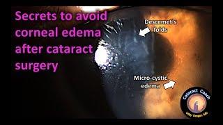 the secrets to avoid corneal edema after cataract surgery