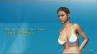 Breast Reduction