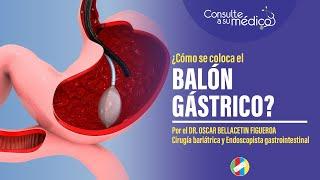 ¿Cómo se coloca un balón gástrico?