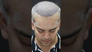 Hair Restoration Results Post 10 Days of Hair Transplant Treatment | Hair Transplant in Ahmedabad