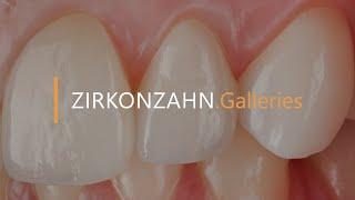 Ultra-thin veneers in Prettau® 4 Anterior® Dispersive® | Zirkonzahn.Galleries