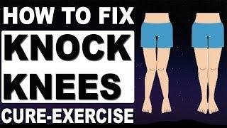 Exercises to Fix Knock Knees - Problem Solution 100% Working | How to cure knock knees at home