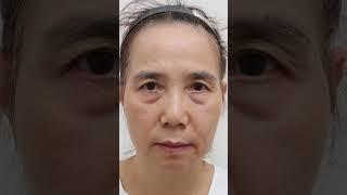하안검은 언제 어떻게 할까? #shorts