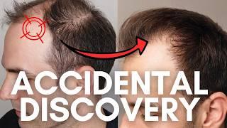 NEW Hair Growth Experiment - Better Than Minoxidil & Finasteride!