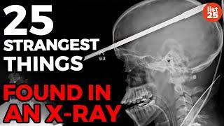 25 Strangest Things Found In An X-Ray