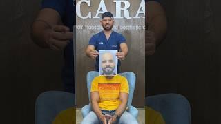 "Before and After: The Incredible Sapphire FUE Hair Transplant Journey at CARA"